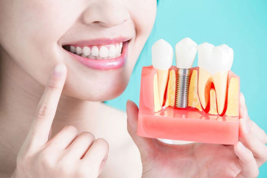 What are the Benefits of Mini Dental implants? - Orange County Centers for  Oral Surgery and Dental Implants